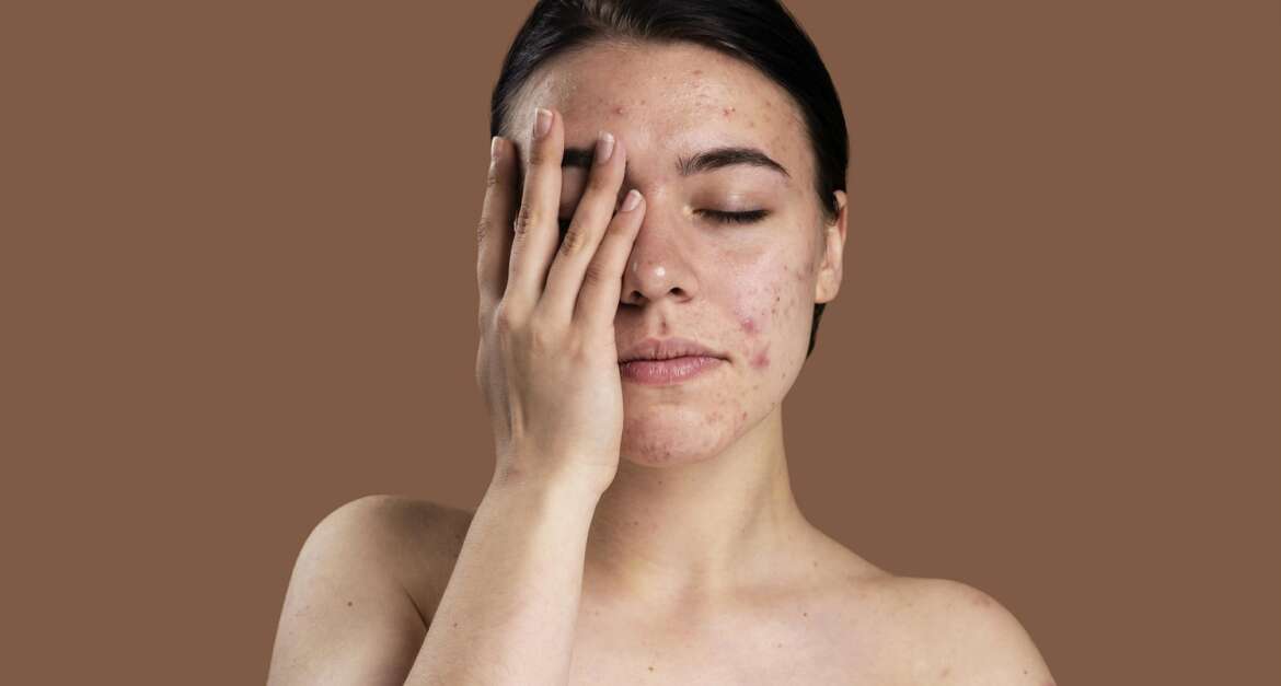 Skin Diseases