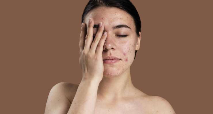 Skin Diseases